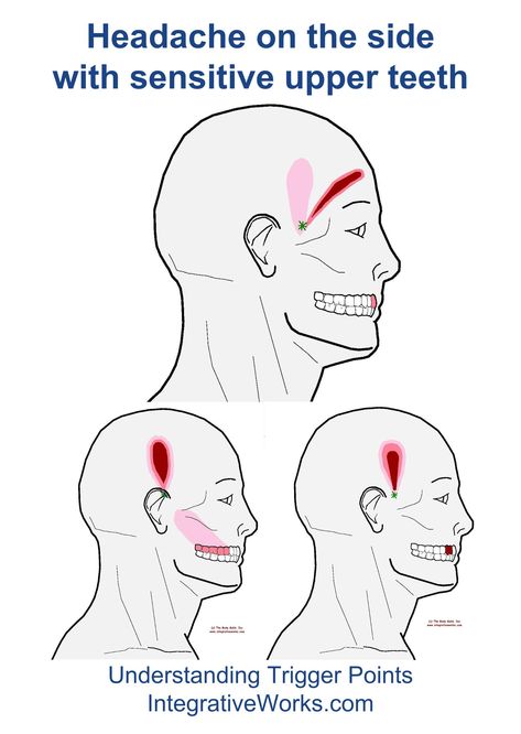 Understanding Trigger Points - Headache with sensitive upper teeth Punkty Spustowe, Natural Teeth Whitening Diy, Natural Teeth Whitening Remedies, Holistic Dentistry, Sensitive Teeth Remedy, Coconut Oil For Teeth, Black Teeth, Teeth Whitening Remedies, Teeth Whitening Diy