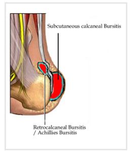 Achilles Bursitis, Heel Bursitis, Achilles Pain, Joints Pain Remedy, Pain Relief Remedies, Back Pain Remedies, Ankle Pain, Foot Pain Relief, Joints Pain Relief