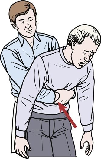 Heimlich maneuver Stand/kneel behind victim and wrap arms around waist. Make fist with one hand. Place thumb side of fist against victim's abdomen. Position fist above navel and below breastbone. Press fist into victim's abdomen using quick upward thrusts.If victim is in late stage of pregnancy or obese, chest thrusts should be used. Position hands over lower portion of the breastbone, apply quick backward thrusts. Repeat until object is expelled or victim is unresponsive. Heimlich Maneuver, Tomato Nutrition, Health Benefits Of Ginger, Ginger Benefits, Coconut Health Benefits, Art Of Manliness, Benefits Of Coconut Oil, Survival Tips, Emergency Preparedness