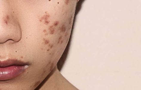 Hyperpigmentation: Causes, Symptoms, Types, And Treatments Blind Pimple, Post Inflammatory Hyperpigmentation, Treating Hyperpigmentation, Cbd Oil Benefits, Best Face Wash, Types Of Acne, Skincare Blog, Acne Remedies, How To Treat Acne