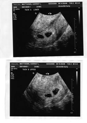 3 Weeks Pregnant Ultrasound Twins, Usg Pregnancy Twins, Twin Ultrasound 6 Weeks, Twins Manifestation, 3 Weeks Pregnant Ultrasound, 5 Week Ultrasound Pictures, 4 Weeks Pregnant Ultrasound, 5 Weeks Pregnant Ultrasound, Fake Ultrasound