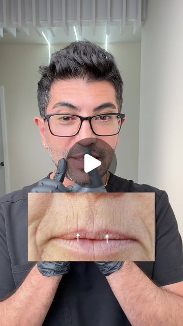 Sirak Darbinian, MD on Instagram: "How to get rid of Smokers Lines …#botox #smokerslines #filler" Smokers Lines, Beauty Treatments, Health And Wellness, On Instagram, Instagram