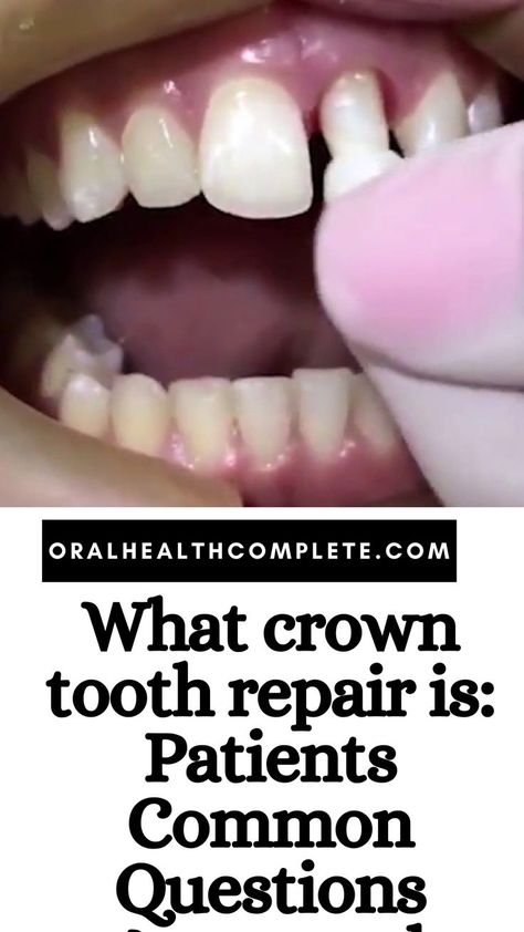 What crown tooth repair is Tooth Bridge, Tooth Implant, Tooth Crown, Tooth Repair, Dental Restoration, Teeth Implants, Dental Bridge, Dental Crowns, The Dentist