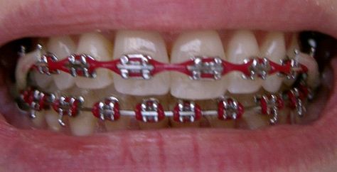 Image Power Chain, Red Power Chain Braces, Power Chains, Red Braces Teeth, Red Braces Aesthetic, Red Braces Color, Dark Red Braces, Maroon Braces, Burgundy Braces