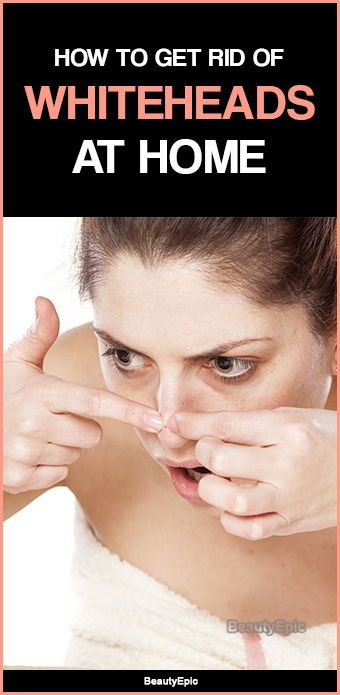 Getting Rid Of Whiteheads On Face, Remove White Heads From Face, Whiteheads On Nose, Diy Whitehead Removal, Remedy For White Heads On Face, Face Pack For White Heads, How To Get Rid Of White Heads On Nose, How To Get Rid Of White Heads On Face, White Head Removal Diy