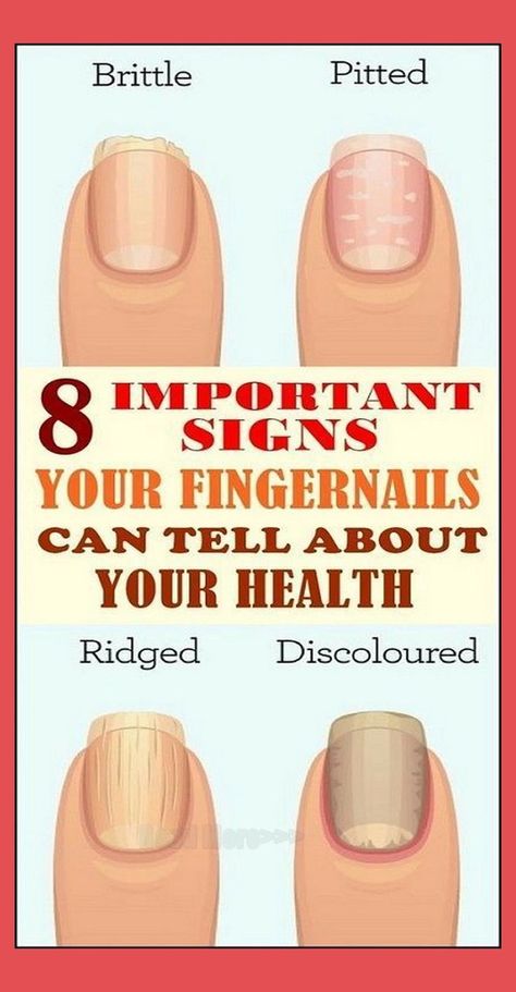 8 IMPORTANT SIGNS YOUR FINGERNAILS CAN TELL ABOUT YOUR HEALTH Nail Growth Faster, Nails And Health, Nail Conditions, Body Attack, Recipe Hacks, Milky Nails, Nails Health, Tongue Health, John Brown