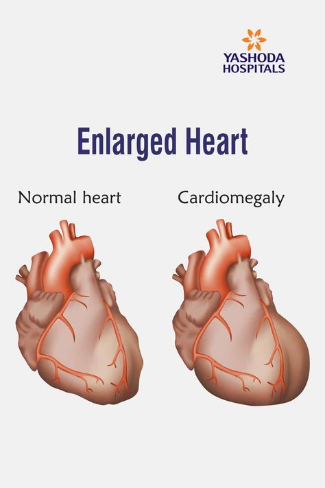 Heart Valve, Enlarged Heart, Heart Rhythm, Lung Transplant, Heart Valves, Normal Heart, Heart Muscle, Heart And Lungs, Healthy Diet Tips