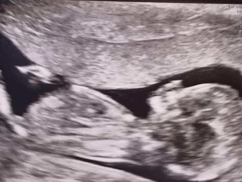 14 week scan - reversal of vasectomy by Mr Duncan Harriss Girl Ultrasound, Ramzi Method, Nub Theory, 20 Week Scan, Boy And Girl, Ultrasound, Image Collection