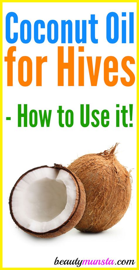 Essential Oil For Hives, Natural Remedies For Hives, Home Remedies For Hives, Hives Remedies, Chronic Hives, Natural Beauty Hacks, Natural Antihistamine, Losing 40 Pounds, Home Remedy For Cough