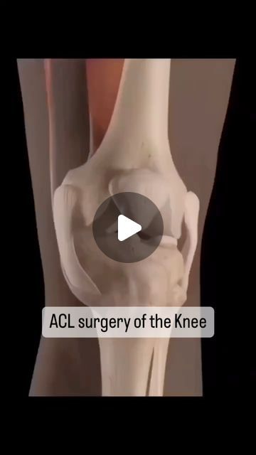 Science Optics on Instagram: "Anterior cruciate ligament (ACL) reconstruction surgery. - - - A partial or complete tear of the ACL in the knee is a common injury among athletes. - - In ACL reconstruction surgery, a new ACL is made from a graft of replacement tissue from one of two sources: 1) a portion of the patient's own hamstring, quadriceps or patellar tendon 2) an allograft (tissue from a human organ donor) - - The type of graft used for each patient is determined on a case-by-case basis. - - ACL reconstruction surgery is performed using minimally invasive arthroscopic techniques, in which a combination of fiber optics, small incisions and small instruments are used. A somewhat larger incision is needed, however, to obtain the tissue graft. - - ACL reconstruction is an outpatient ( Knee Injury Pics, Acl Tear Symptoms, Small Instruments, Arthroscopic Knee Surgery, Acl Knee, Patellar Tendon, Acl Reconstruction Surgery, Acl Injury, Acl Recovery