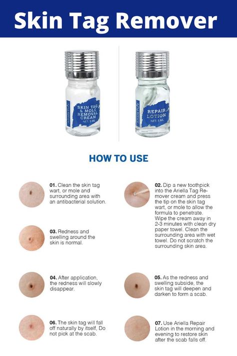 Remove Moles, Remove Skin Tags Naturally, Skin Moles, Tag Remover, Losing 40 Pounds, Mole Removal, Skin Tags, Cold Sores Remedies, Natural Sleep Remedies