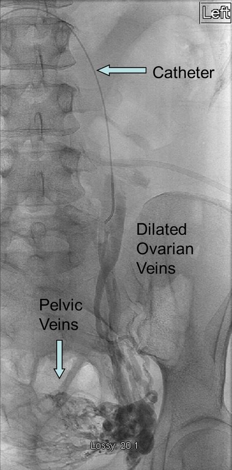 Psoas Muscle Pain, Pelvic Congestion Syndrome, Painful Bladder Syndrome, Pelvic Floor Therapy, Female Health, Psoas Muscle, Spoonie Life, Pelvic Pain, Pelvic Floor