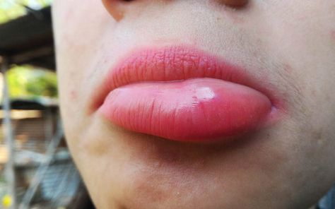 Swollen Lips: Causes, Home Remedies, Medical Treatments & Precautions – SkinKraft Swollen Lip Remedy, Lip Infection, Lip Allergy, Blister Remedies, Blister On Lip, Swollen Lips, Sore Lips, Stomach Cramps, Lower Lip