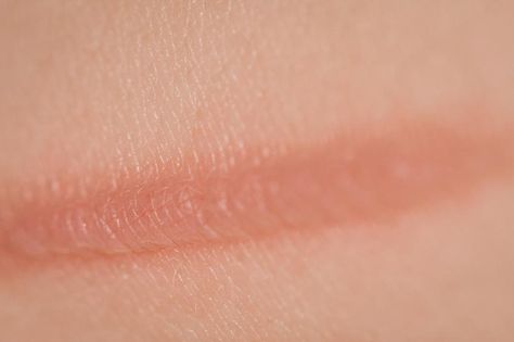 How to Get Rid of Burn Marks on the Skin with Home Remedies. At least once in our lives, we've bumped into a hot skillet or been surprised by some drops of boiling oil on our skin. Burns are the one of the most common household accidents. The annoying thing is ... How To Get Rid Of A Burn On Skin, Skin Burn Remedy, Burn Mark On Skin, What To Put On Burns On Skin, Burn Scar Remedies, Hand Burns Skin, Burns On Skin, Face Burn, Curling Iron Burn