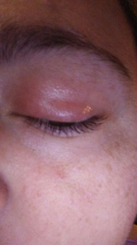 This was my eye infection before using my oils. And now my eye is back to normal. Http://mydoterra.com/wellness trio Eye Infections, And Now, Essential Oils, Quick Saves