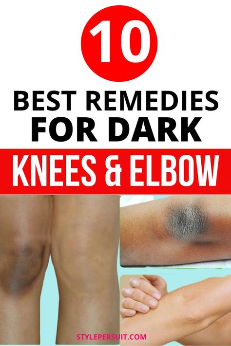 Darkened knees and elbows are common concerns, often caused by an accumulation of dead skin cells, friction, or sun exposure. Unlike other areas of the skin, knees and elbows tend to be drier and thicker, which can lead to hyperpigmentation. Fortunately, there are several natural remedies that can help lighten and even out the skin tone on these areas. Click to discover the 12 effective remedies: Dark Knees And Elbows Remedies, How To Lighten Knees, Dark Knees And Elbows, Dark Knees, Dark Elbows, Lighten Skin Tone, Beauty Hacks Skincare, Dark Underarms, Reduce Hyperpigmentation