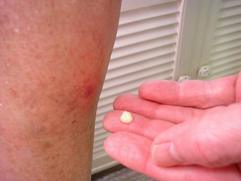 Wart Whisperer: Home Remedies That Really Work #Warts #Wart #WartRemoval #HomeRemedies #HealthTips #BeautyHacks #DIYRemedies Food Grade Hydrogen Peroxide, Herb Gifts, Peroxide Uses, Home Remedies For Warts, Hydrogen Peroxide Uses, Warts Remedy, Health Heal, Diy Remedies, Hydrogen Peroxide