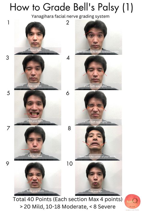 This is Yanagihara facial nerve grading system for Bell's palsy. Nine types of facial movements considering left-right symmetry at rest and each branch of the facial nerve are graded into three levels: "almost normal (4 points)," "partial paralysis (2 points)," and "severe paralysis (0 points). Total 40 points. If you have more than 20 points, it is considered a Mild case; if you have between 10-18 points, it is moderate. You have severe Bell's Palsy if you have less than 8 points. #bellspalsy Bell Palsy Exercises, Facial Palsy Exercise, Bells Palsy Facial Exercises, Bells Palsy Exercises, Bells Palsy Remedies, Facial Nerve Branches, Facial Movements, Orofacial Myofunctional Therapy, Bell’s Palsy