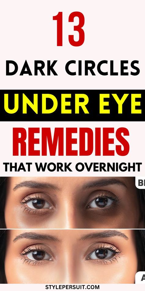 Struggling with dark circles under eye? Learn the causes, symptoms, and a range of dark circles natural remedies you can try at home to effectively treat and minimize them. Eye Circle Remedies, Dark Circle Remedies, Dark Circles Around Eyes, Dark Eye Circles, Dry Skin Remedies, How To Get Rid Of Pimples, Sore Eyes, Remove Dark Circles, Under Eyes