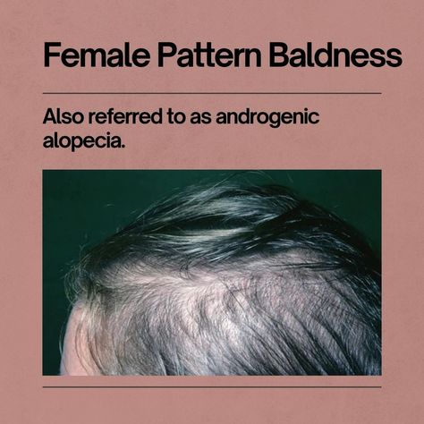 Female pattern baldness (androgenic alopecia) is a type of hair loss that causes baldness in women. Scroll through to learn more about its causes and symptoms.
.
Save this pin and share with a friend.
.
.
#femalepatternbaldness #androgenicalopecia #haircare #naturalhairtips #tipsforhair Androgenic Alopecia In Women, Androgenic Alopecia, Female Pattern Baldness, Androgenetic Alopecia, Game Storage, Pattern Baldness, Bald Women, Skin Clinic, Natural Hair Tips