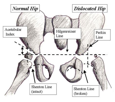 LearningRadiology - Developmental Dislocation/Dysplasia of the Hip Developmental Dysplasia Of The Hip, Hip Anatomy, Physical Therapy School, Pediatric Nurse Practitioner, Physical Therapy Assistant, Hip Problems, Basic Anatomy And Physiology, Human Body Anatomy, Hip Dysplasia