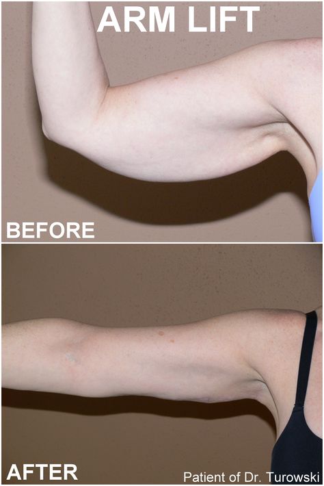 Arm Surgery Plastic Before After, Thigh Lift Before And After, Mommy Makeover Surgery Recovery, Arm Surgery, Arm Lift Surgery, Body Lift Surgery, Skin Removal Surgery, Body Plastic Surgery, Lipo Before And After