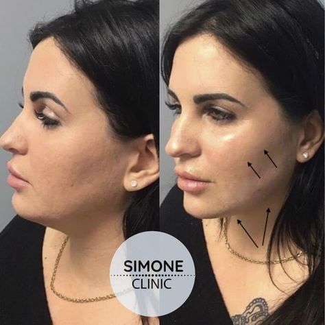 Cheekbone Filler, Jaw Filler, Soprano Ice Laser, Anti Wrinkle Injections, Cheek Fillers, Porcelain Skin, Nasolabial Folds, Anti Aging Tips, Dermal Fillers