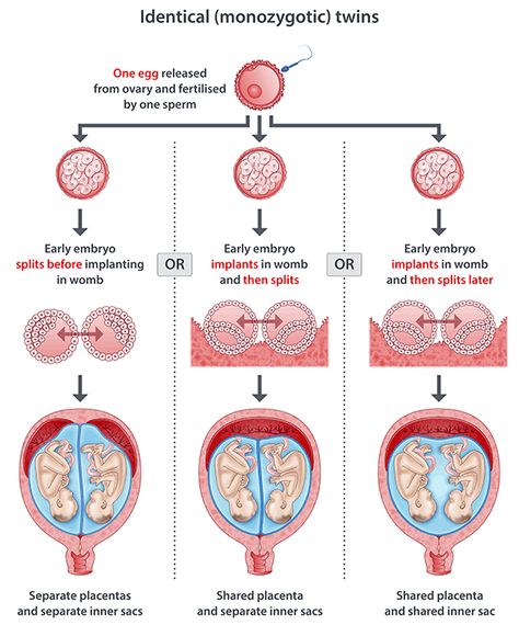 identical twins illustration - mine are the first: 2 placentas and 2 sacs. the egg split during first 1-3 days. fascinating Identical Twins Ultrasound, Trying To Conceive Twins, Types Of Twins, Usg Pregnancy Twins, How To Get Pregnant With Twins, Get Pregnant With Twins, Midwifery Student, Ob Nursing, Fraternal Twins