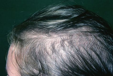 Female-Pattern Baldness ~ Hair loss in women may mean hair thinning all over the head, but is usually most common on top of the head. Unlike men, women rarely go bald, and they tend to lose hair more slowly than men do. Contrary to popular belief, longer hair wont put a strain on the roots, causing more to fall out. Nor will shampooing pull hair out -- it just gets the ones that were falling out already. Minoxidil may help hair growth and prevent thinning. Thining Hair, Help Hair Growth, Female Pattern Baldness, Male Pattern Baldness, Pattern Baldness, Bald Hair, Female Hair, Grow Hair Faster, Lost Hair