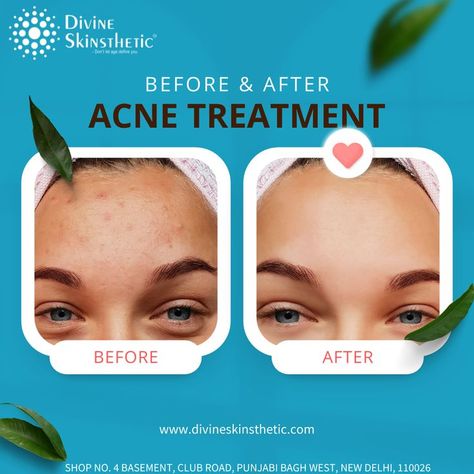 Acne Social Media Design, Before And After Creative Ads, Before After Social Media Post, Before After Skincare, Healthcare Inspiration, Before And After Acne, Optician Marketing, Skincare Ads, Beauty Poster