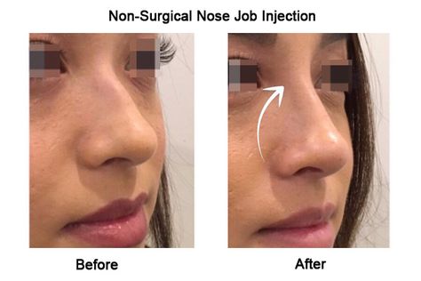 This liquid nose job is done under precise doctors to prevent excessive blood loss in surgical methods. The technique is safe and tested. Nonsurgical Nose Job Before And After, Non Surgical Nose Job Before After, Nose Injections Before And After, Filler Nose Job Before After, Nose Massage Before And After, Liquid Nose Job Before And After, Nose Filler Before After Non Surgical, Liquid Rhinoplasty Before And After, Nose Filler Before After