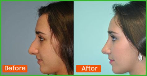 Sharp nose is a symbol of beauty and it fits in with any make up look too. Nose reshape exercises can help improve the shape! Here are top exercises for nose shape How To Reshape Your Nose, Reshape Nose, Make Nose Smaller, Sharp Nose, Nose Reshaping, Nose Makeup, Face Tips, Facial Yoga, Breast Workout