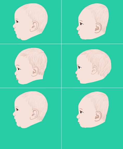 There are ways to prevent baby from developing flat head syndrome. Find out what causes plagiocephaly and treatments to fix the problem. Baby Head Shape, Mum Hacks, Ellie Rose, Flat Head Syndrome, Baby Helmet, Baby Checklist, Baby Prep, Learning Strategies, Kids Gear