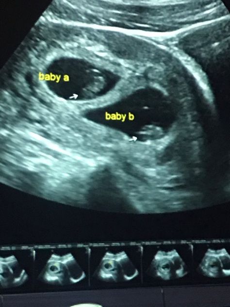 Triplets Ultrasound Pictures, Twin Sonogram Ultrasound, Twin Ultrasound Pictures 8 Weeks, Twins Sonogram, Ultrasound Pictures 8 Weeks, 4 Weeks Pregnant Ultrasound, 6 Weeks Pregnant Ultrasound, Boy Ultrasound, Fake Ultrasound