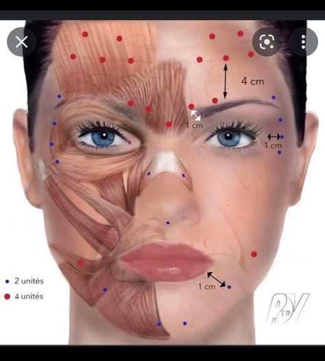 Botox Cream, Botox Injection Sites, Face Plastic Surgery, Dermal Fillers Lips, Skin Mapping, Botox Lips, Aesthetic Dermatology, Botox Cosmetic, Botox Face