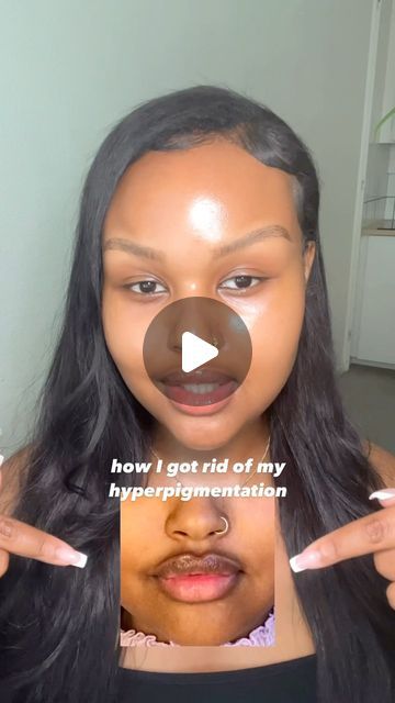 Kadija Ali on Instagram: "I tried a lot of different products but only started seeing results once I started using sunscreen in my skincare routine.   Wearing sunscreen in combination with tyrosinase inhibitors (alpha arbutin, tranexamic acid, azelaic acid etc), chemical exfoliants & retinoids will target and fade hyperpigmentation!  Do you wear sunscreen? 🤍" Tyrosinase Inhibitors, Skincare Combination, Products For Hyperpigmentation, Sunscreen For Combination Skin, Alpha Arbutin, Lactic Acid Skincare Routine, Skincare Routine For Hyperpigmentation, Azelaic Acid Routine, Best Skincare For Hyperpigmentation