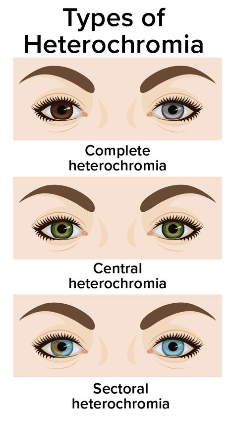 Sectoral Heterochromia Brown, 2 Different Color Eyes, Central Heterochromia Eyes, Heterochromia Eyes Aesthetic, Beauty Subliminal, Different Color Eyes, Sectoral Heterochromia, Central Heterochromia, Eyes Type