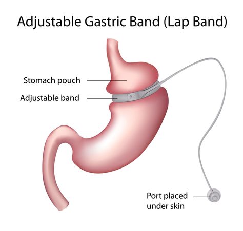 Lap Band, Gastric Band, Bariatric Surgeon, Sleeve Gastrectomy, Sleeve Surgery, Surgery Center, Gastric Bypass, Reduce Weight, Plastic Surgery