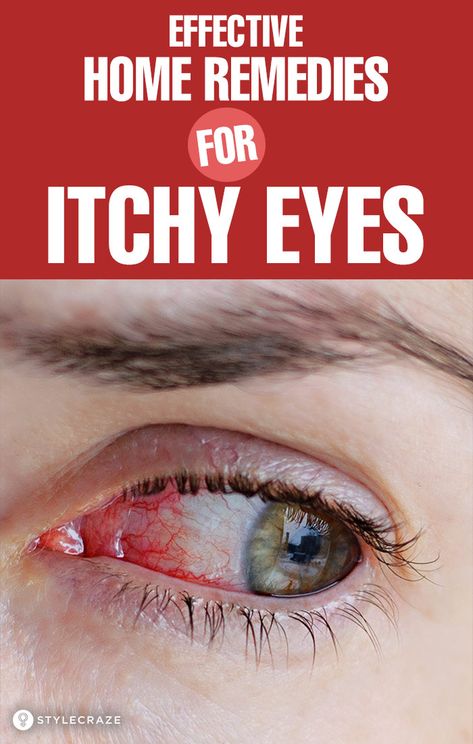 Itchy Eyes Remedy, Remedies For Itchy Eyes, Allergy Eyes, Dry Eyes Causes, Irritated Eye, Itchy Eyes, Sore Eyes, Eyes Problems, Dry Eyes