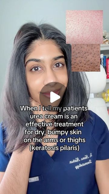 Dr. Neera Nathan | Keratosis pilaris (also known as “chicken skin” or “strawberry skin”) is a condition that is caused by dry, excess skin around th... | Instagram Strawberry Skin How To Get Rid, Chicken Skin Remedy, Strawberry Skin, Keratosis Pilaris, Excess Skin, Bumpy Skin, Chicken Skin, Acne Solutions, Acne Care