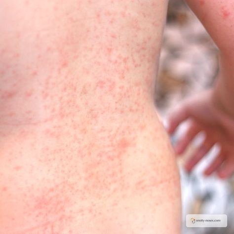 Remedies For Heat Rash, Heat Rash On Face, Treating Heat Rash, Skin Rash Remedies, Heat Rash Remedy, Baby Heat Rash, Home Remedies For Rashes, Prickly Heat Rash, Fever Rash