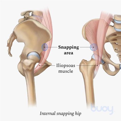 Snapping Hip Syndrome, Greater Trochanter, Iliotibial Band, Bursitis Hip, Tight Hamstrings, Gluteus Medius, Muscle Weakness, Primary Care Physician, Sports Coach