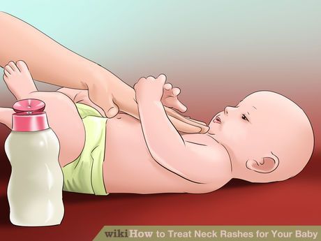 Image titled Treat Neck Rashes for Your Baby Step 2 Heat Rash Remedy For Babies, Baby Neck Rash, Treating Heat Rash, Newborn Rash, Heat Rash Remedy, Baby Heat Rash, Viral Rash, Baby Skin Rash, Neck Rash