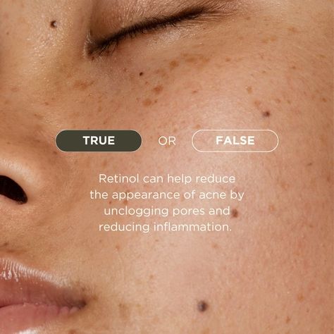 True Or False Skincare Edition, Esthetician Marketing, Skin Facts, Instagram Branding Design, Skin Advice, Skin Aesthetics, Social Media Branding Design, True Or False, Aesthetic Clinic