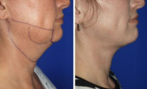 Face Lipo Before And After, Double Chin Lipo Before And After, Neck Lipo Before And After, Chin Lipo Before And After, Lipo Before And After, Smart Lipo, Laser Lipo, Saggy Skin, Fat Removal