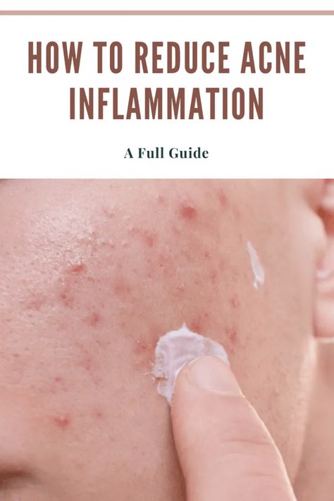 Inflamed Skin, Healing Acne, Acne Inflammation Remedies, Inflammatory Acne, Natural Remedies For Hormonal Acne, What Causes Fungal Acne, Inflammatory Acne Remedies, Healing Hormonal Acne, Nodular Acne