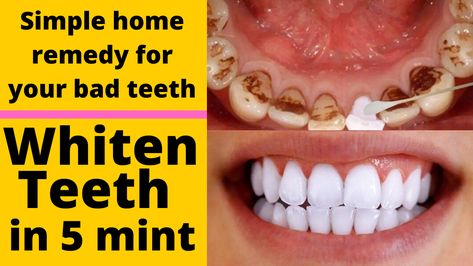 Home Teeth Whitening Diy, Make Teeth Whiter, Whiten Your Teeth At Home, Home Teeth Whitening, Skin Care Home Remedies, Teeth Whitening Remedies, Teeth Whitening Diy, Bad Teeth, Kids Teeth