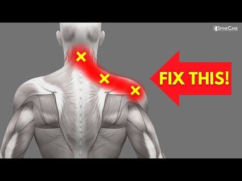 How to INSTANTLY Fix Pinched Nerve Pain in the Neck and Shoulders - YouTube Pinched Nerve In Shoulder, Pinched Nerve In Neck, Neck Muscle Pain, Trapped Nerve, Neck Pain Exercises, Sciatic Nerve Relief, Exercise For Beginners, Neck And Shoulder Exercises, Neck Hurts