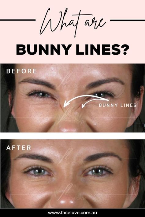 Bunny Lines Botox Units, Bunny Lines Botox Before And After, Botox Injection Points, Botox For Frown Lines, Nose Tip Lift Botox Before And After, Aesthetic Procedures, Nose Wrinkles, Botox Brow Lift Injection Site, Aesthetic Cream