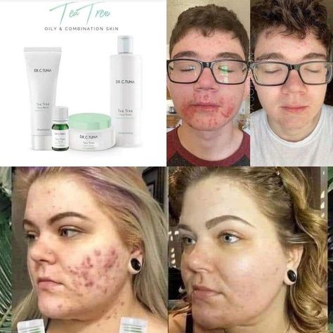 Mamas with teens that struggle with Acne!! This line has been an absolute GAME CHANGER for these kiddos right here👏🏻👏🏻👏🏻 Tea Tree Skincare, Tea Tree Cleanser, Skincare Package, Skincare Sets, Smooth Glowing Skin, Moisturized Skin, Skin Clear, The Curse, Skincare Set